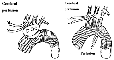 Aortic Arch Replacement