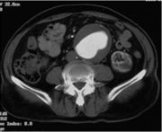 典型的な腹部大動脈瘤のCT写真